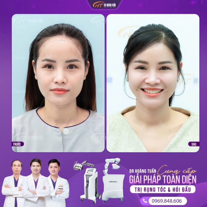 Hạ đường chân tóc. Bảng giá mới năm 2025